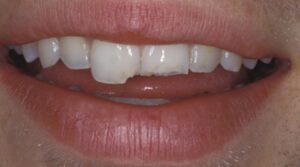 Dente Quebrado: O Que Fazer Imediatamente e Quando Procurar o Dentista