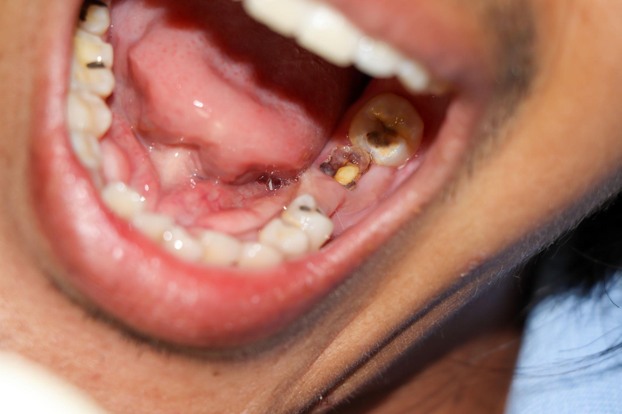 Tratamento de Canal: Mitos, Medos e o Que Realmente Acontece na Cadeira — Cuidar do Dente Hoje Evita Decisões Difíceis Amanhã