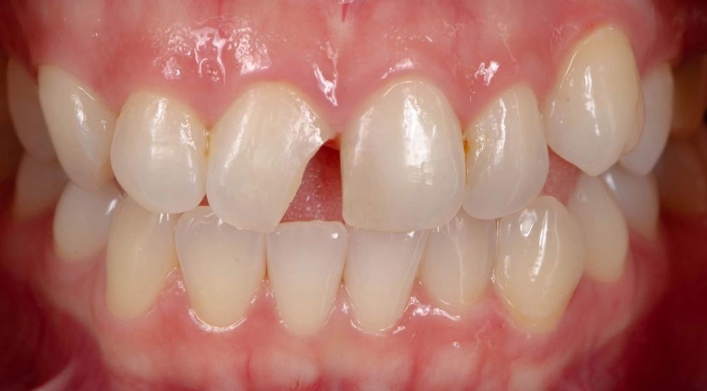Dente Quebrado: O Que Fazer Imediatamente e Quando Procurar o Dentista — Sorriso Restaurado na Odontonápolis