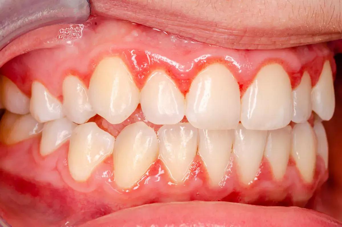 Dor na Gengiva: Sinais de Alerta Que Você Não Deve Ignorar — Sua Gengiva Merece Cuidado Especializado na Odontonápolis