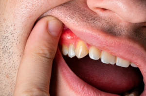 Caroço na gengiva: o que pode ser e quando ir ao dentista